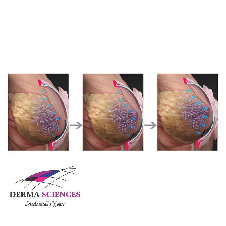 Breast Enlargement Machine The Derma Sciences