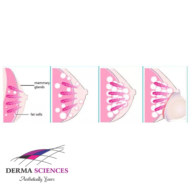 Breast Enlargement Machine The Derma Sciences